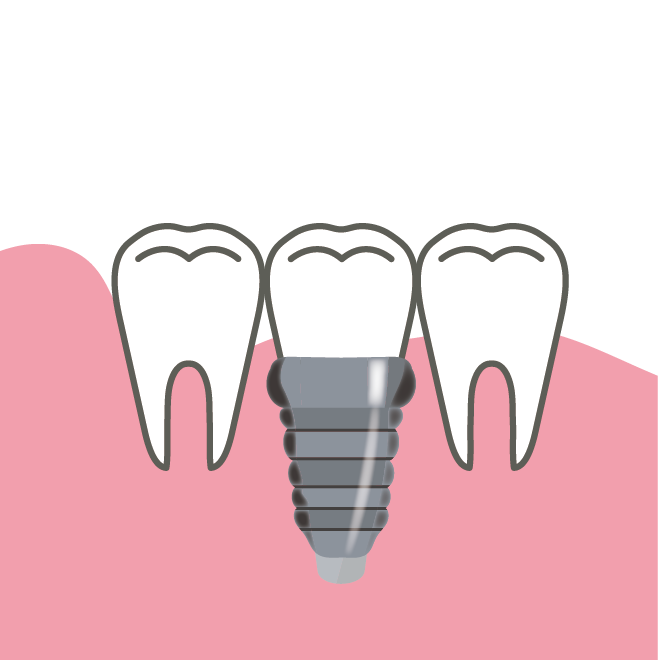 インプラント治療した歯のイラスト 商用フリー 無料 のイラスト素材なら イラストマンション