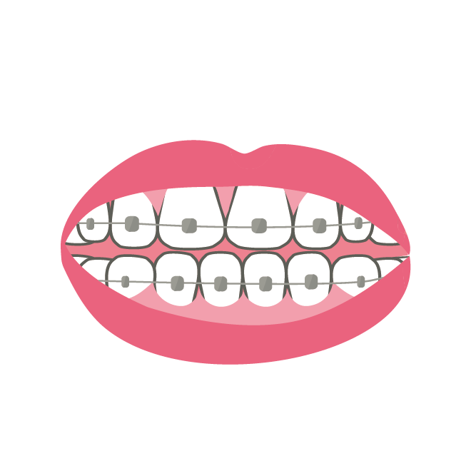 矯正治療中の歯 口元 のイラスト 商用フリー 無料 のイラスト素材なら イラストマンション