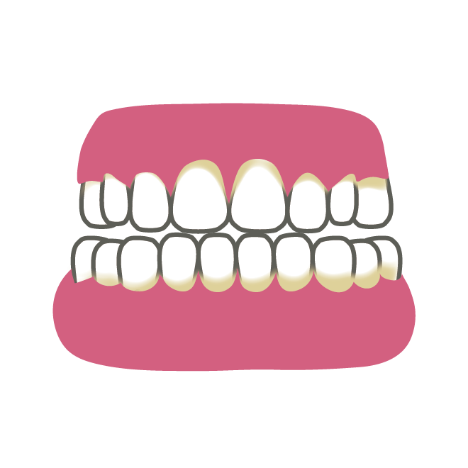歯垢 プラーク が溜まってしまった歯のイラスト 商用フリー 無料 のイラスト素材なら イラストマンション