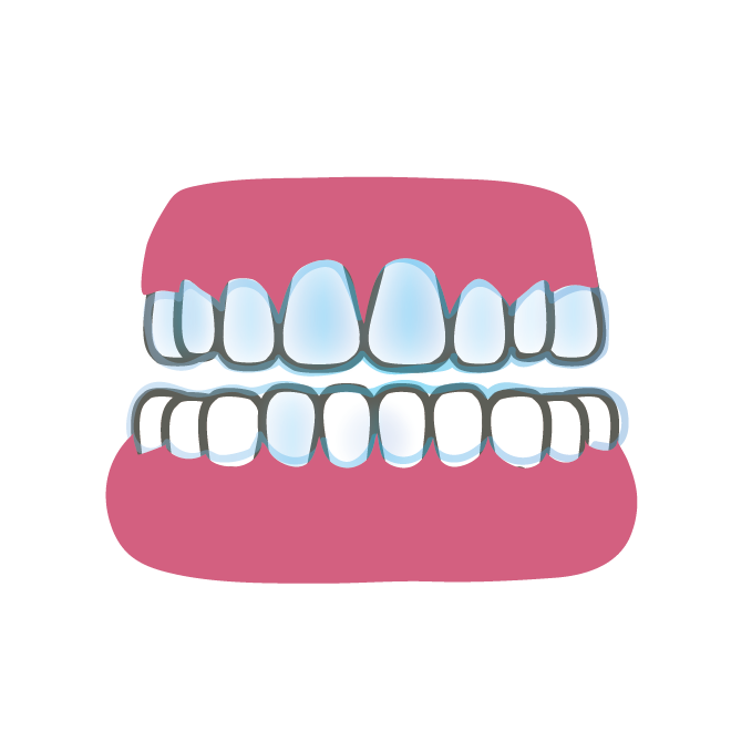 インザビライン 歯科矯正 のイラスト 商用フリー 無料 のイラスト素材なら イラストマンション